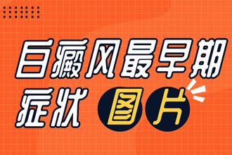 白癜風的早期癥狀該如何發(fā)現(xiàn)